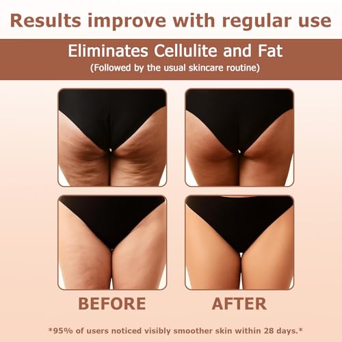 Cellulite Roll™ Anti-Cellulite Massage Roller for Thighs
