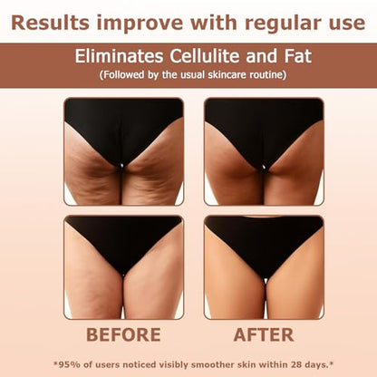 Cellulite Roll™ Anti-Cellulite Massage Roller for Thighs